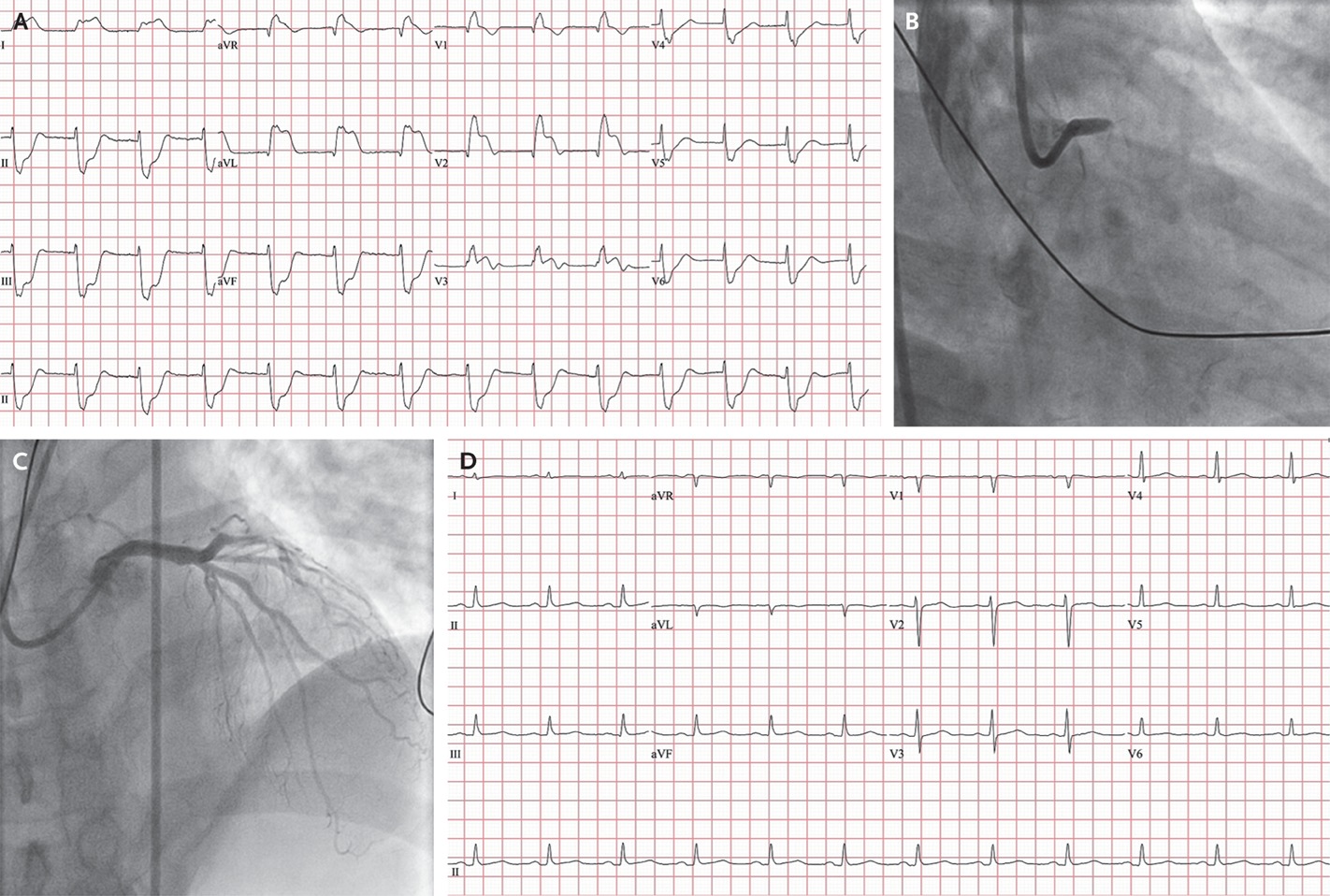 ишемическая болезнь сердца поражение миокарда. поражение левой коронарной артерии. шунтирование коронарных артерий показания. коронарные венечные сосуды. ангиография коронарных сосудов.