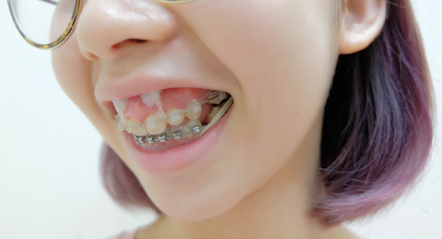 braces upper teeth tooth pull string second story final rubber band put stage between screws together because