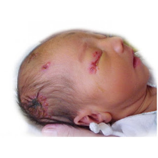 Obat Tradisional Penyakit Herpes pada Bayi