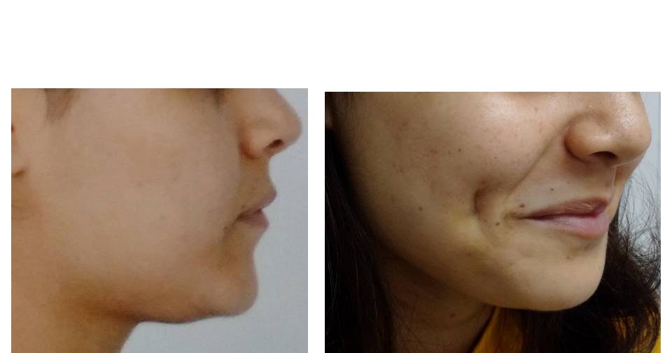 DR. ASHISH GUPTA HIGHLIGHT YOUR SMILE WITH DIMPLES