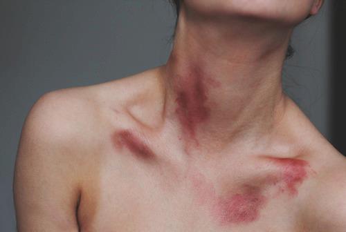 moretones en el cuerpo mujer