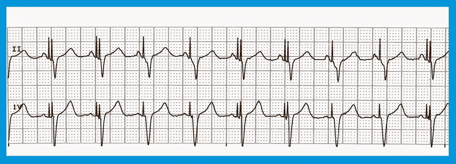 Biventricular Pacemaker