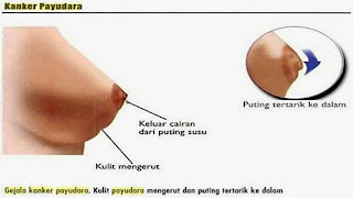 jenis tanaman obat kanker payudara, kanker payudara disebabkan, pengobatan kanker payudara dengan avail, mengobati kanker payudara dengan pijatan, nama obat kanker payudara, penyembuhan kanker payudara metode terapi, gejala awal timbulnya kanker payudara, obat kanker payudara, gejala kanker payudara jinak, vaksin kanker payudara, obat ramuan penyakit kanker payudara, kanker payudara pdf usu, tanda kanker payudara stadium 3, kanker payudara her2 positif, kanker payudara non invasive, obat kanker payudara selain daun sirsak, kanker payudara gejala awal pada pria, obat gejala kanker payudara, jus untuk mengobati kanker payudara, tumbuhan yang dapat menyembuhkan kanker payudara, pengobatan medis untuk kanker payudara, mengobati kanker payudara kakaknya, kemungkinan sembuh kanker payudara stadium 4, vaksin kanker payudara news, operasi kanker payudara stadium 4, cara efektif mengobati kanker payudara, tumbuhan obat kanker payudara