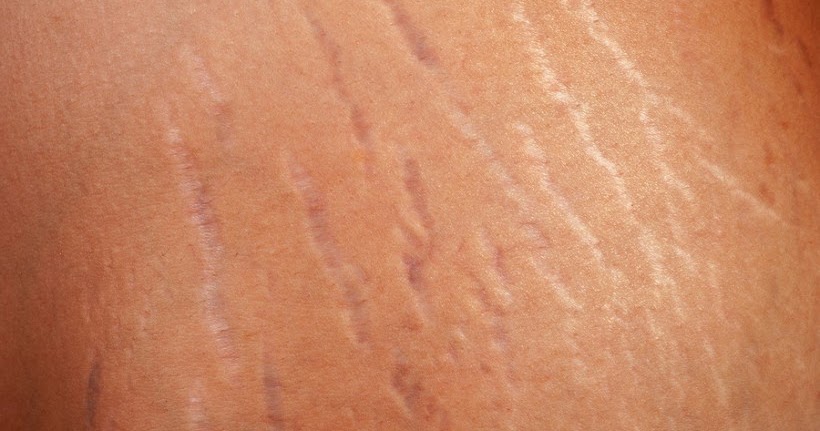 How to get rid of stretch marks in a week - a href="http://w