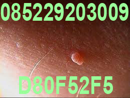Obat Kutil Kelamin Obat Kutil Kelamin