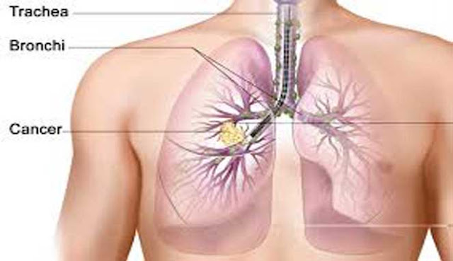 10 JENIS KANKER PALING MEMATIKAN DI DUNIA JENIS KANKER PALING MEMATIKAN DI DUNIA
