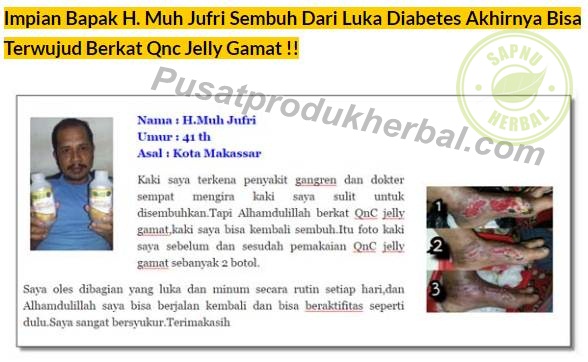 Cara Cepat Mengobati Luka Bakar Tanpa Membekas Cara Cepat Mengobati Luka Bakar Tanpa Membekas