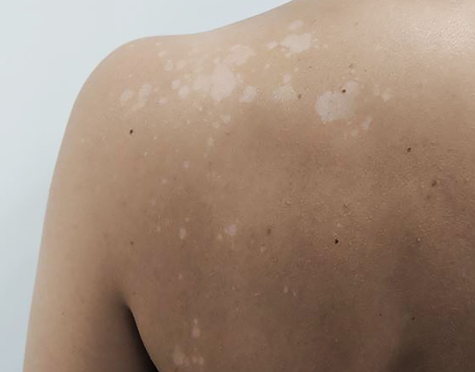Small White Spots On Skin NaturalSkins