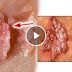 Obat Berbentuk Salep Untuk Kutil Kelamin thumbnail