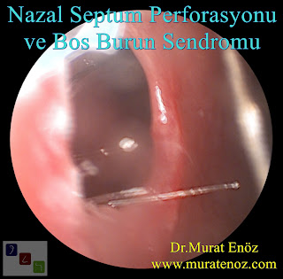 nazal septum perforasyonu + boş burun sendromu