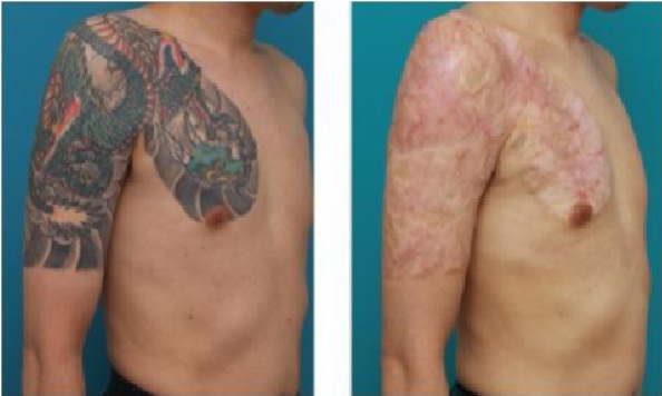 3. Home Remedies for Tattoo Removal - wide 3