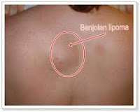 Penyebab, Akibat dan Pengobatan Benjolan di Punggung