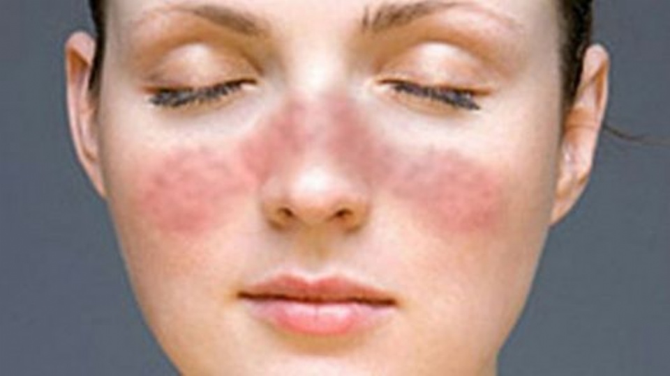 Mengenal Penyakit Lupus dan Cara Mencegah Penyakit Lupus Intips Lagi