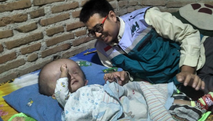 Usai Jalani Operasi, Kondisi Eza Bayi Hidrosefalus asal Kediri Membaik