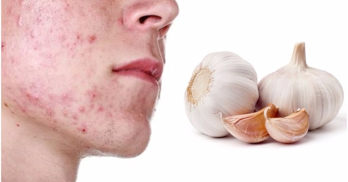 How To Treat Acne Scars With Garlic