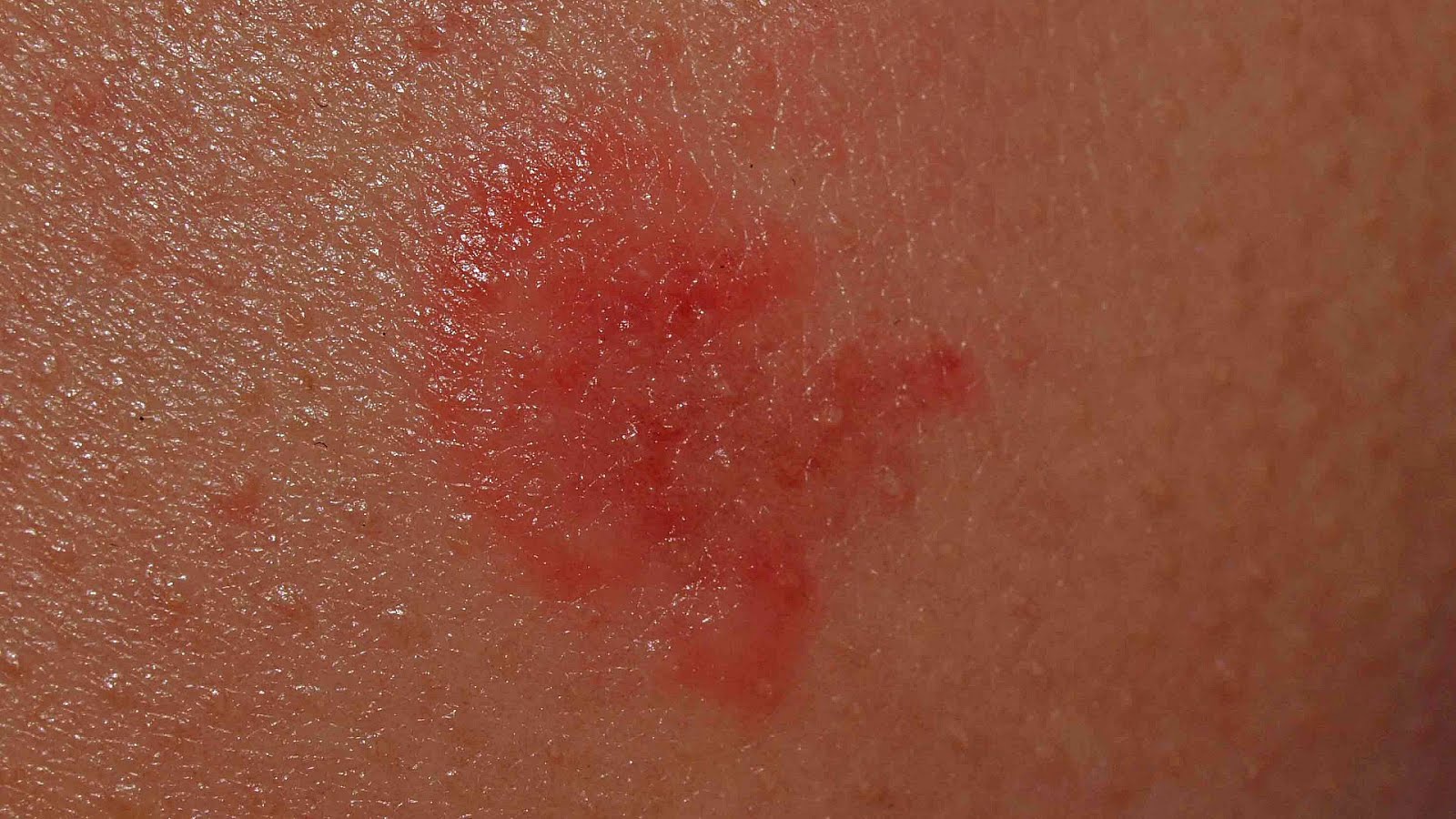 Cholinergic urticaria Menopause Hives Menopause Choices