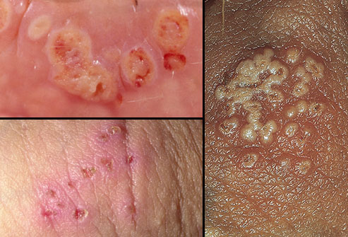https://1.bp.blogspot.com/-pZVjLfyri1U/WQGxAOWlgFI/AAAAAAAAAdY/-3A1OslnyO4T09DRdQTJ-rhyH01dIErfwCLcB/s1600/herpes%2Bdi%2Btubuh.jpg