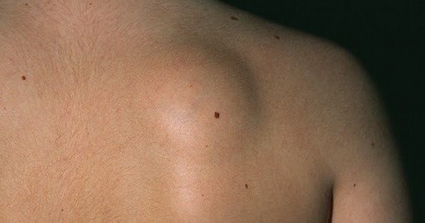 Obat Lipoma Yang Bagus Di Apotik