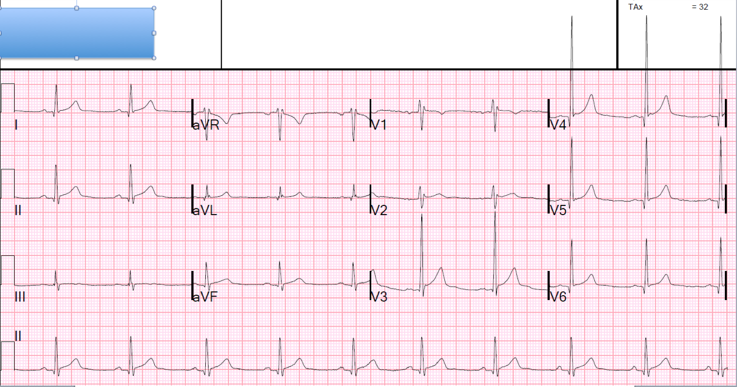 dr-smith-s-ecg-blog-syncope-and-a-possible-type-2-brugada-morphology