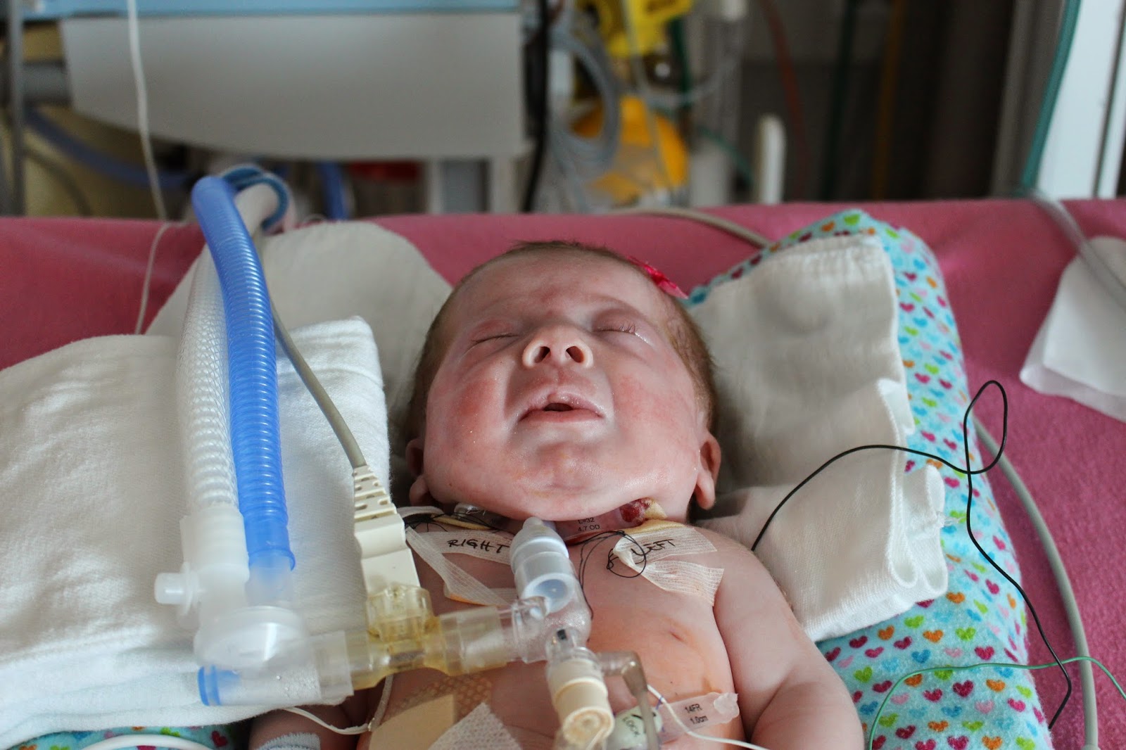 Surgery Tracheostomy & GTube Dear Annie