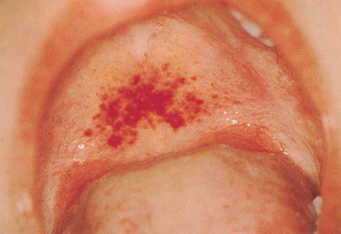 Pictures Of Red Spots On Palate 78