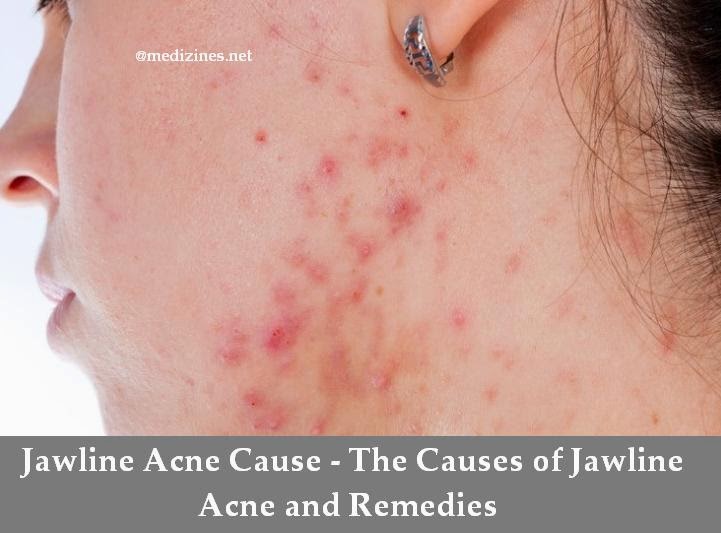 Jawline Acne Cause The Causes of Jawline Acne and Remedies