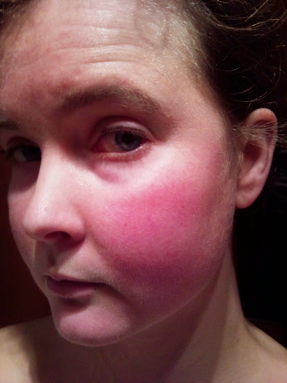 Scarlet Letters, dealing with vascular rosacea, face flushing, burning