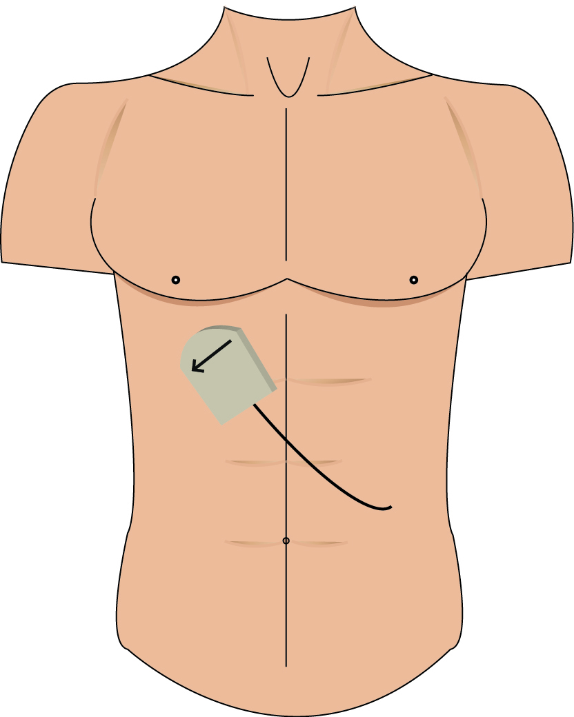 Gallbladder wall thickening= cholecystitis? Ultrasound Cases Info