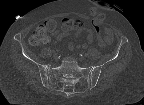 Case of the Month: Fracture cases at Harborview Medical Center ...