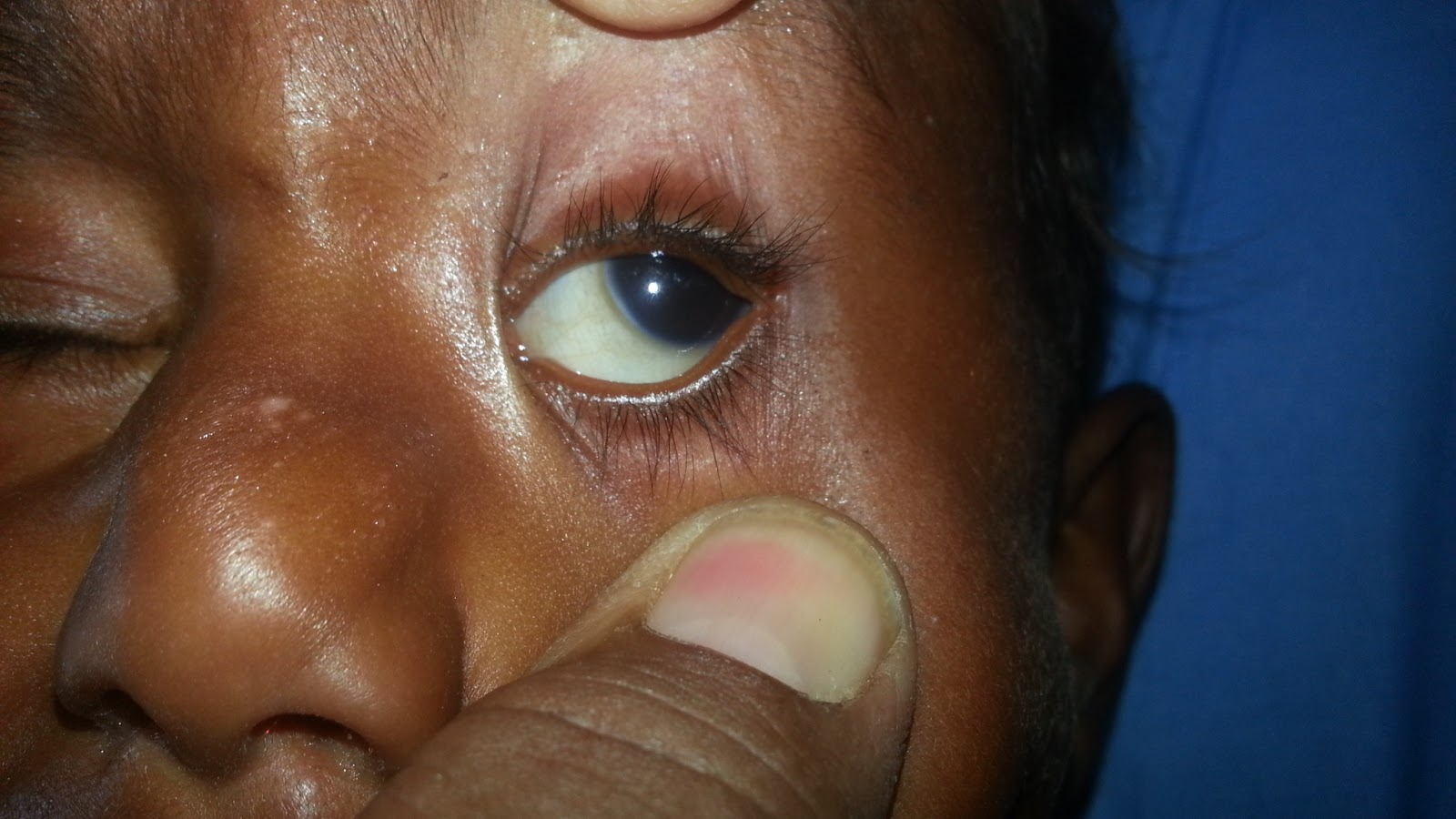 Dr. Mubashir's Pediatric Blog Suspicion KF Ring