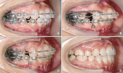 Răng vẩu có di truyền không? Giải đáp từ các chuyên gia 2 Răng vẩu có di truyền không? Giải đáp từ các chuyên gia 2