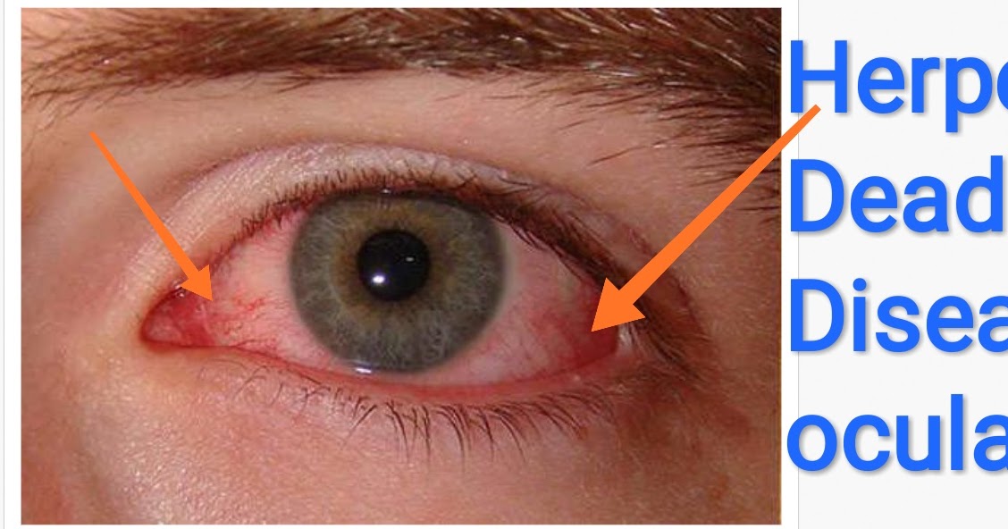 Healthcare & Health solution Herpes Deadly Disease Ocular