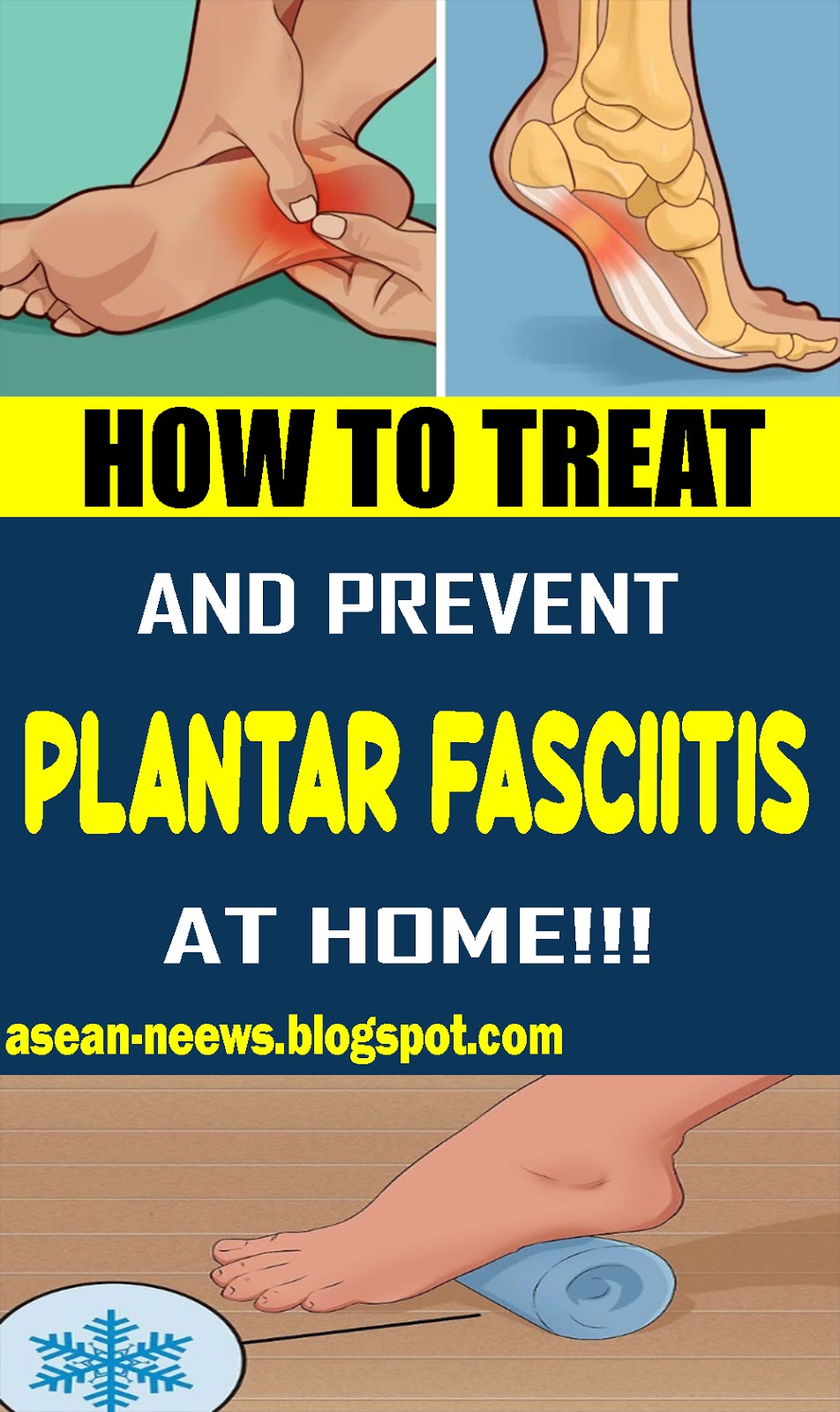 How To Treat And Prevent Plantar Fasciitis at Home