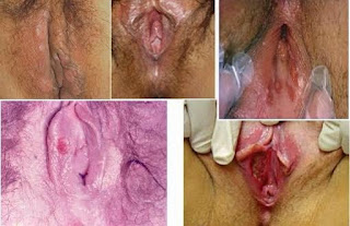 Image Luka Lecet Pada Vagina
