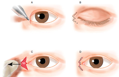 Eyelid Surgery by Prof Dr CN CHUA 蔡鐘能: Doc, Do I Need Operation on My ...