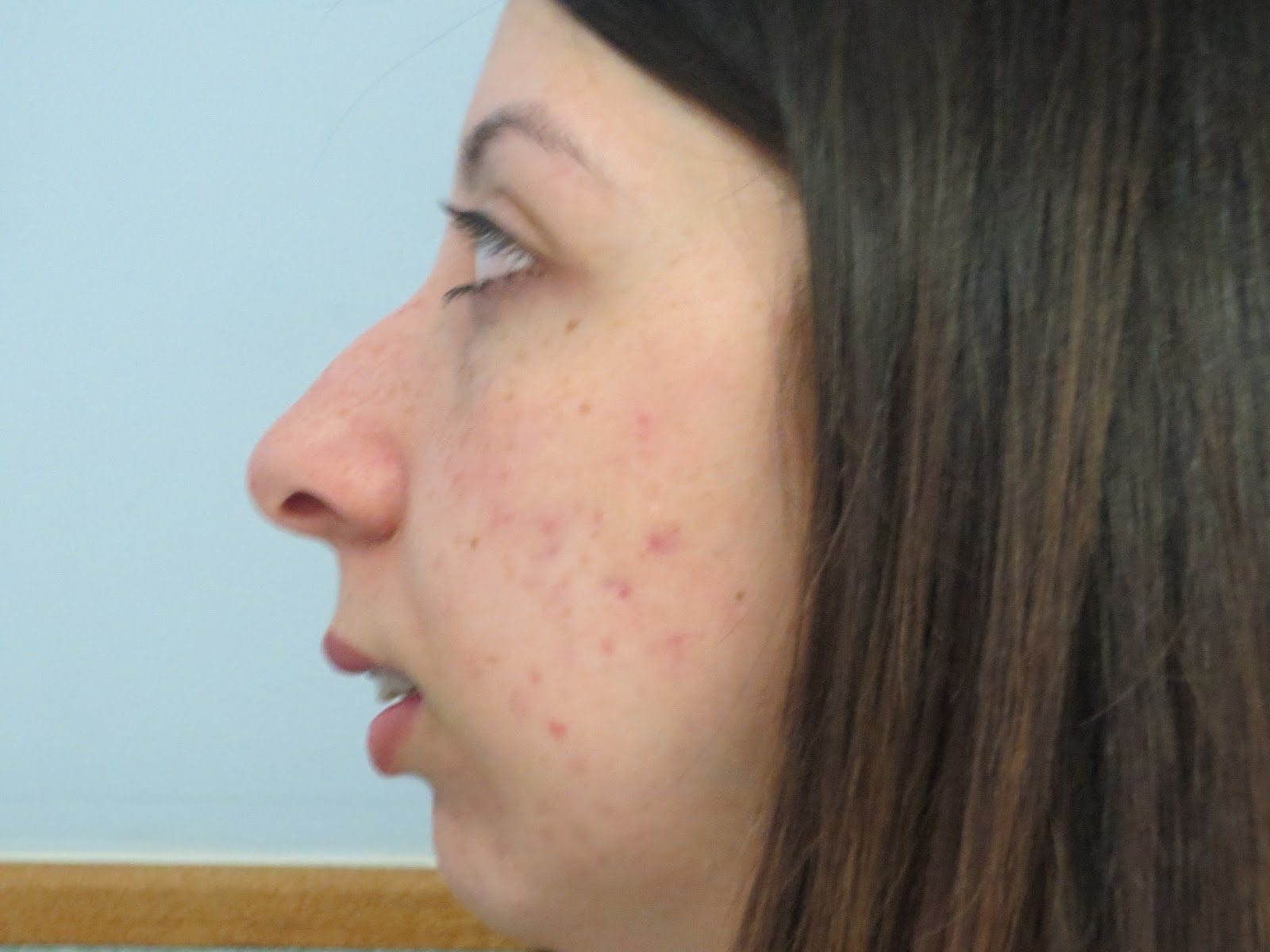 Lauren's Jaw Dairy ) Jaw Surgery Day 11.7.2013