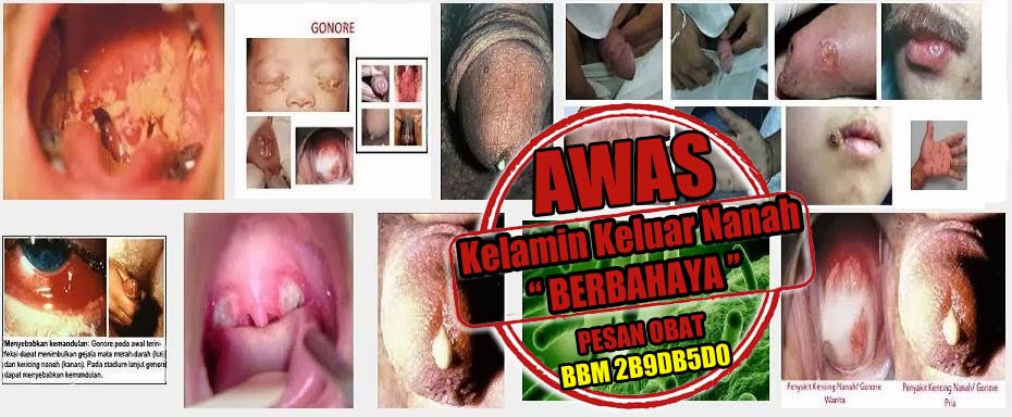 Obat Kelamin Keluar Nanah Manjur Obat Kelamin Keluar Nanah Manjur