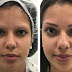 Micropigmentação em sobrancelhas é opção para recuperar autoestima
