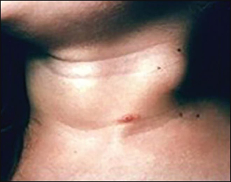 Kikuchi-Fujimoto Disease, Histiocytic Necrotizing Lymphadenitis