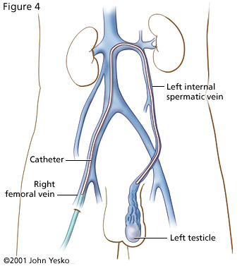 dilatazione plesso prostatico