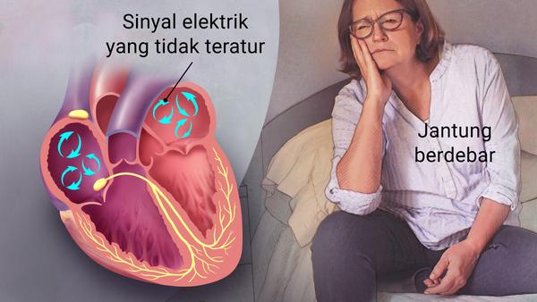 Penyakit Atrial Fibrilation (Afib), Penyakit Jantung Karena Kelelahan