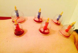 Blood letting Acupuncture in NYC