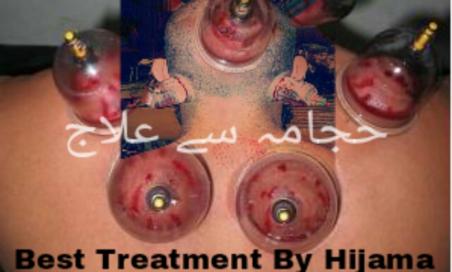 Hijama se ilaj Hijama kaise kare Cupping therapy benefits