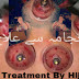 Hijama Se Ilaj | The Best Cupping Therapy In Hindi Urdu Pachhna Lagana