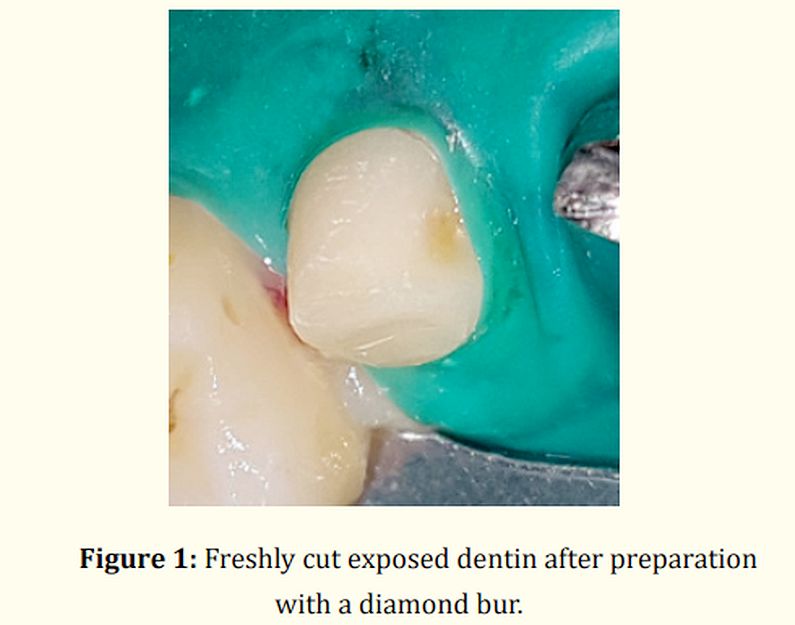 PDF Immediate Dentin Sealing for Indirect Restoration Why and How