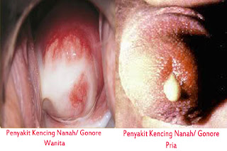 penyakit gonore, penyakit kencing nanah, penyakit gonore atau kencing nanah, penyakit kemaluan keluar nanah