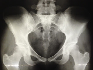 Android pelvis