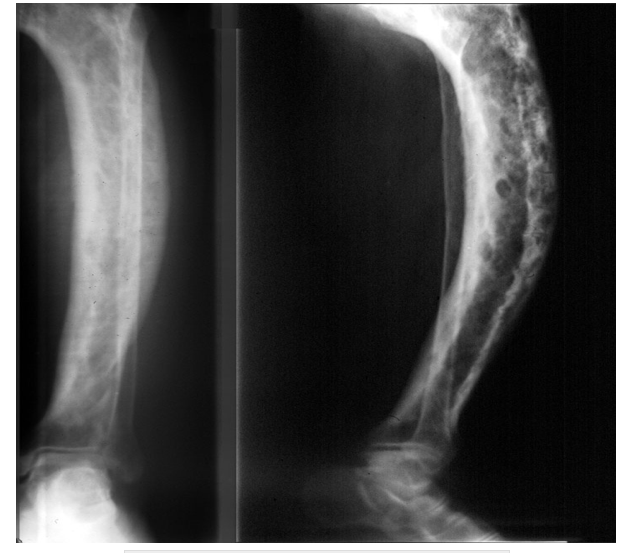Diseases Paget''s Disease Of Bone