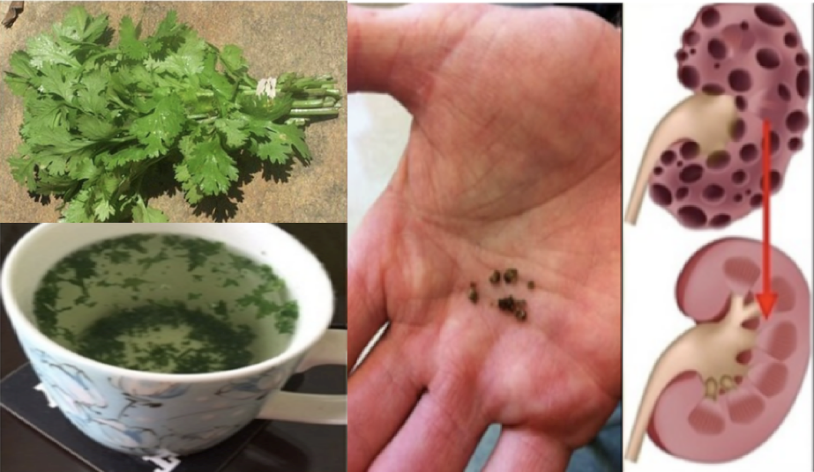 Amazing Home Remedy Will Help You Flush Out Your Kidney Stones Using Parsley Leaves