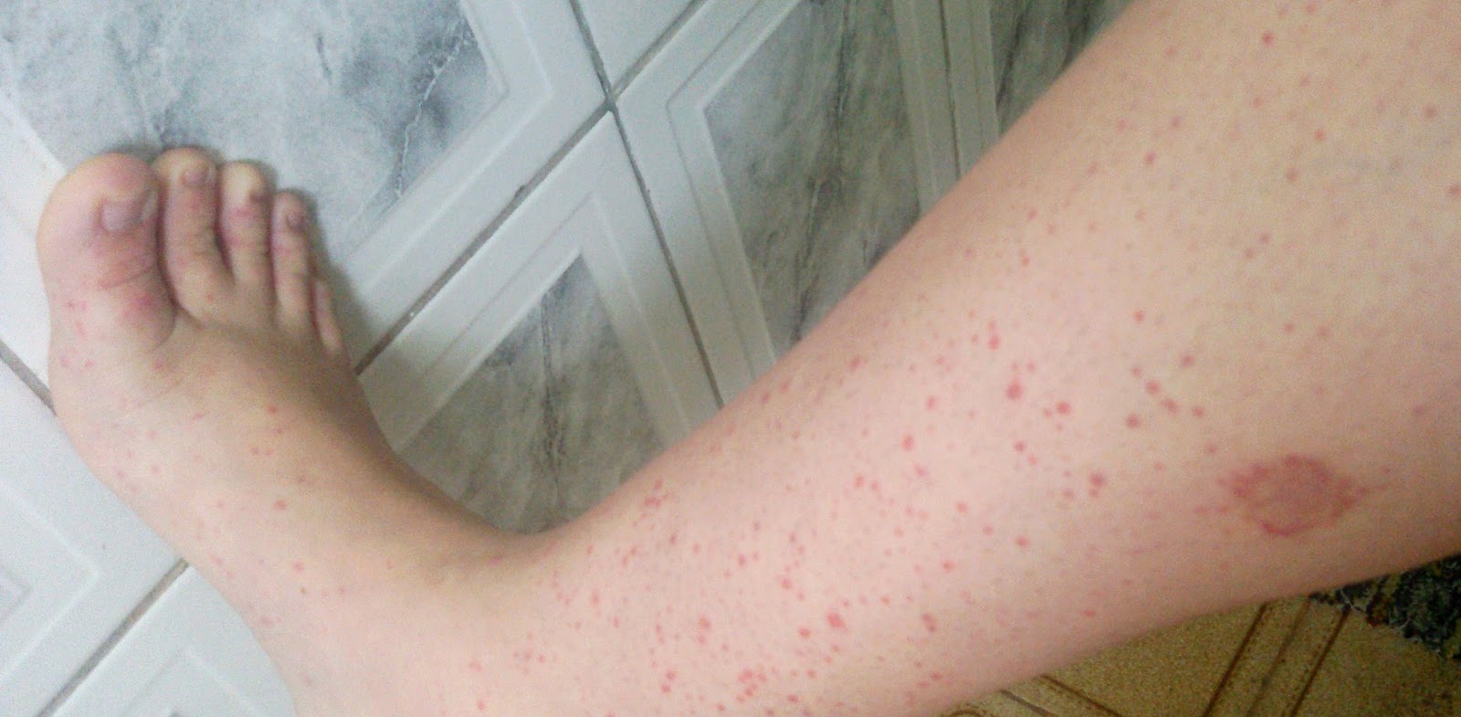 Wikem superficial da tromboflebite